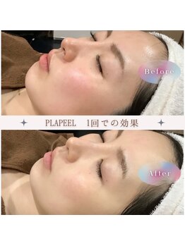 ビューティーモア(more)/最先端毛穴つるりんフェイシャル