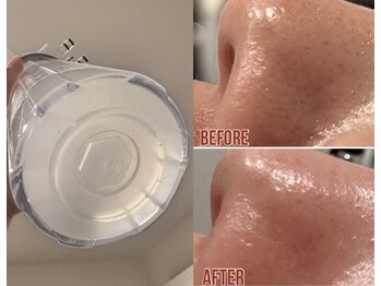 メローワックス 松本駅前店(MELLOW WAX)/大人気毛穴洗浄☆