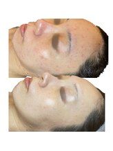 ラリマ(La-lima)/30代女性/ニキビケア