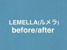 エムフロート(M FLOAT)/lemella/ルメラ/メラニンケア