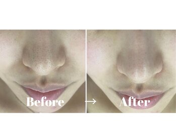 カラーリリー アンド ユン(Calla lily & yun)/ハイドラ毛穴洗浄エステ♪