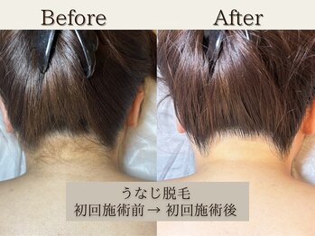 インベスト(INVEST)/うなじ脱毛