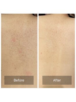 ビビ(VIVI)/背中の毛孔性苔癬に☆