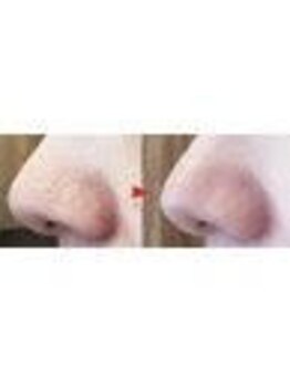 ハーゼ(Hase)/ハイドラフェイシャル◎毛穴洗浄