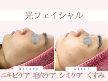 Cスキンケアクリニック 麻布店/光フェイシャルBeforeAfter