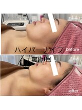 ルヴェール 久屋公園(le verre)/ハイパーナイフ 顔・デコルテ