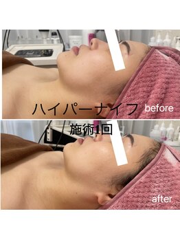 ルヴェール 久屋公園(le verre)/ハイパーナイフ 顔・デコルテ