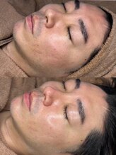 ホワイトアクア 京都店(WHITE AQUA)/ララピールでツヤ肌に/京都