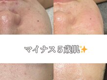 サロンノワ(salon noix)/《マイナス５歳肌が叶う》