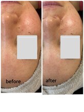 サロン カレア(Salon Kalea)/毛穴洗浄×ハーブピーリング