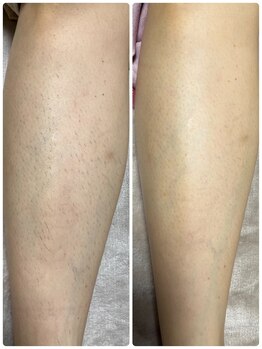 リラキュート(Rela Cute)/施術1ヶ月後シェービングいらず