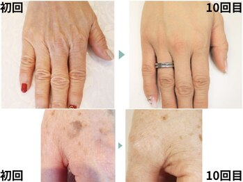 年齢の出る手【手のエステ】