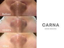 カルナ(CARNA)/超音波3D毛穴洗浄