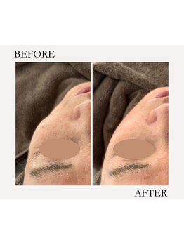 ホウレイ線・たるみ改善！予防ケア