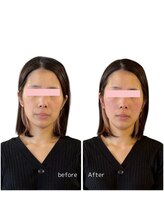 ニコディア(nico-dia)/(20代)美容鍼