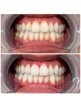 エクシアホワイトニング 日本橋店/水天宮前ホワイトニング