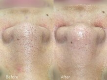 ミュー 春日井店(mieux)/◆肌質改善例