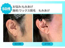 ムーンサン(Moon sun)/ワックス脱毛　もみあげ