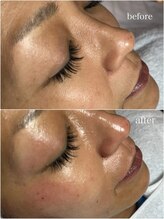 スパークル/毛穴/しわ/しみ改善/脱毛