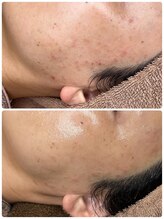 アウラプラス(Aura+)/ニキビケア症例/