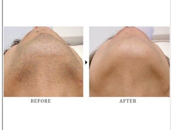 ヴィーヴ 京橋(vive)/【脱毛】ひげ 7回目