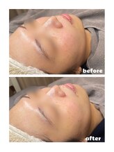 プティジョナ(Petit Jona)/◆ハイドロ毛穴洗浄◆