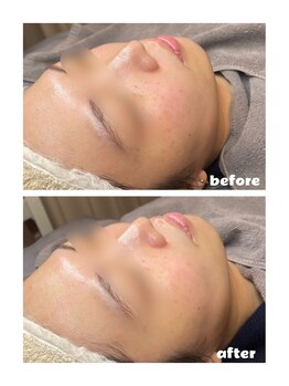 プティジョナ(Petit Jona)/◆ハイドロ毛穴洗浄◆