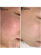 プラセル(Placer)/赤みはお肌のSOS