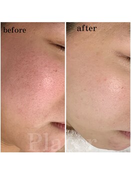 プラセル(Placer)/赤みはお肌のSOS