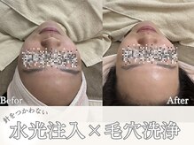 マヴィ 香里園店(MavY.)/つや肌☆ノンニードル水光注入