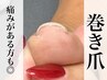 【足の巻き爪施術】1本¥5500→¥3300
