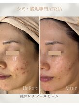 アトリア(ATRIA)/純粋レチノールピール