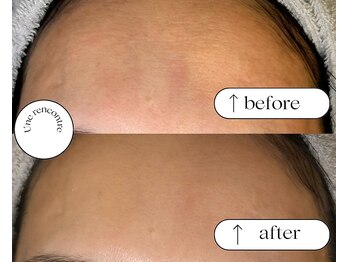 ユヌランコント 岐阜店(Une rencontre)/エンビロン×ラジオ波