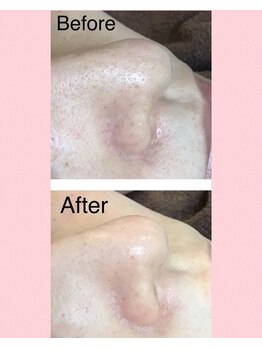 エヴァーグレース 河原町店/京都河原町の毛穴改善美肌サロン