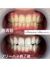 【学割U24】ホワイトニング３週間通い放題に20回照射保証します！メンズOK