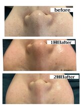 ディオーネ 湘南藤沢店(Dione)/毛穴シミ♪フェイシャルケア