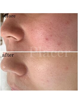 プラセル(Placer)/赤みが落ち着くと毛穴にも変化が
