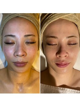 レアリゼ(Realiser)/お顔の赤みを抑える