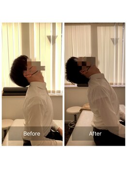 ナオル整体 新宿院(NAORU整体)/20代男性-猫背矯正Before/After