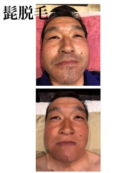 ひとつno武器/メンズヒゲ脱毛