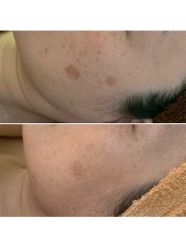 エクシア(ECXIA)/マイルドな角質ケアとシミケアで