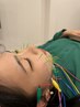 【目元・フェイスライン集中】美容鍼+電気パルス+小顔矯正
