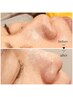 WAXで頬・鼻の毛穴スッキリ♪不要な物除去＆炭酸パックで毛穴レスな肌に!