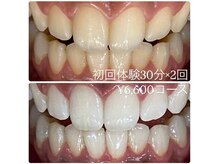ホワイトニングルーム 横浜店(Whitening Room)/ホワイトニング/横浜
