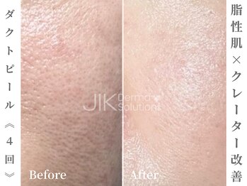 ゼアー(THERE FY.)/年齢とともに垂れた毛穴に