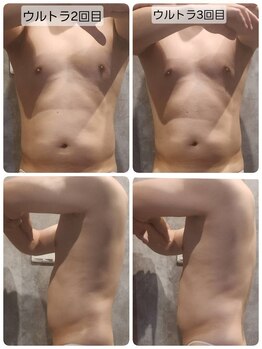 ヴィトワ(Vitowa)/ウルトランスフォーマー施術例5