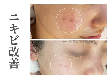 エトレ(etre)/月1サロン/肌管理プログラム