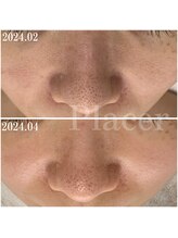 プラセル(Placer)/2ヶ月の変化