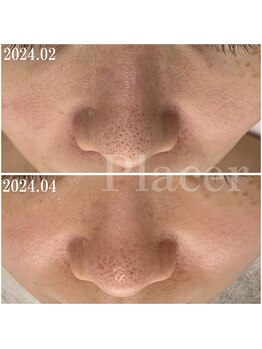 プラセル(Placer)/2ヶ月の変化