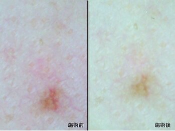 ビューティーデイ バイ オーキッド(BEAUTY DAY by ORCHID)/シミケア専用光フェイシャル